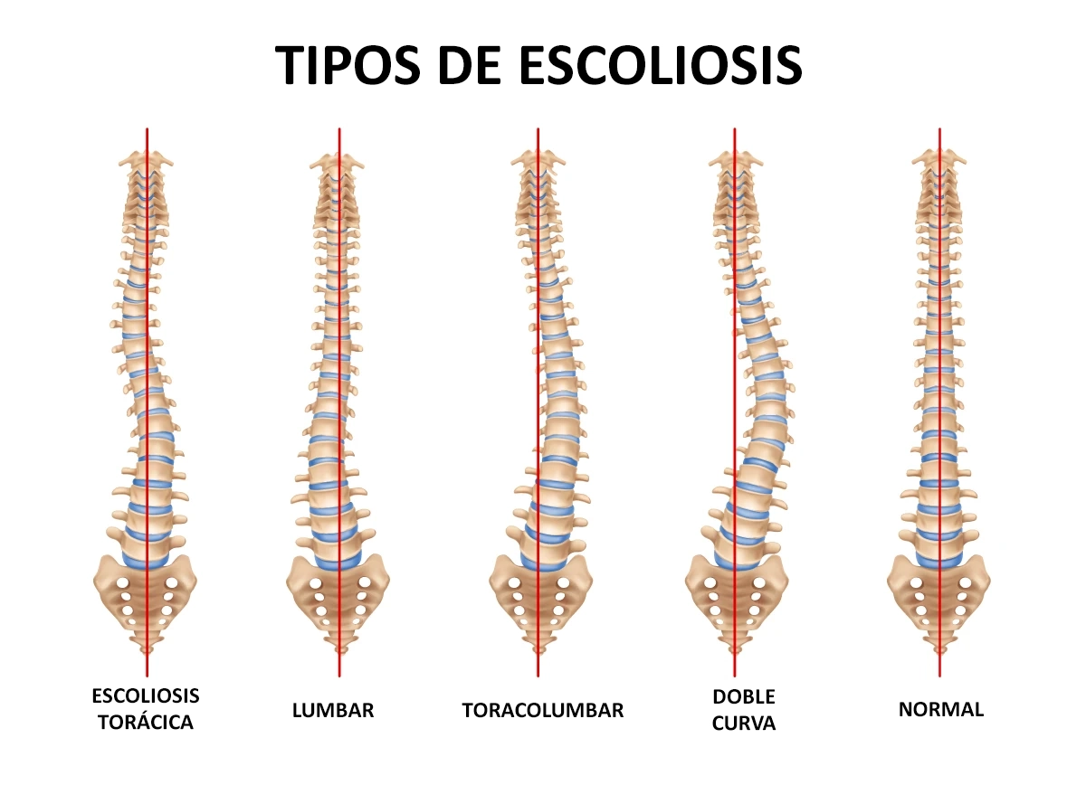 escoliosis