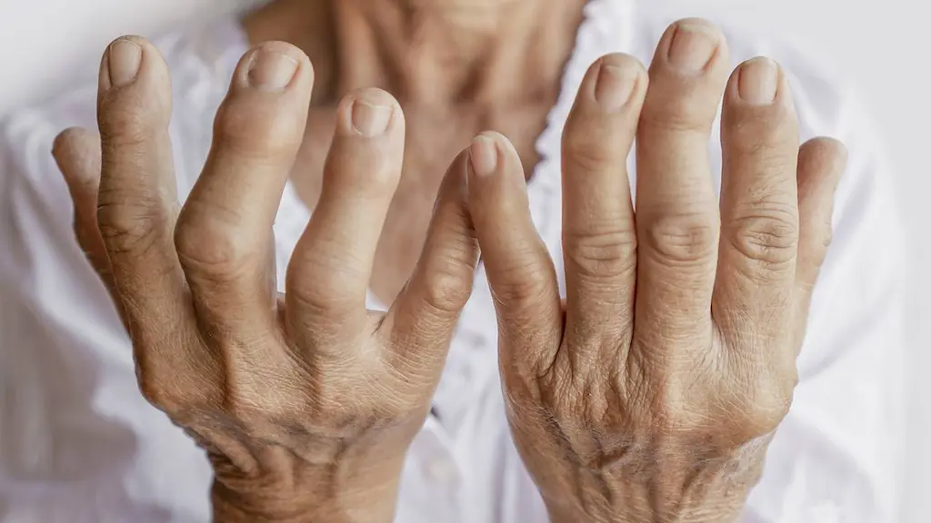 Qué es la artritis reumatoide y cuáles son sus causas, síntomas y soluciones