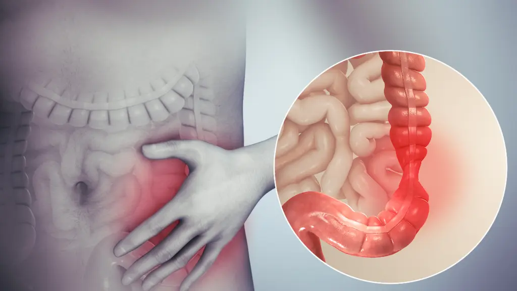 Síndrome del Intestino Irritable (SII)