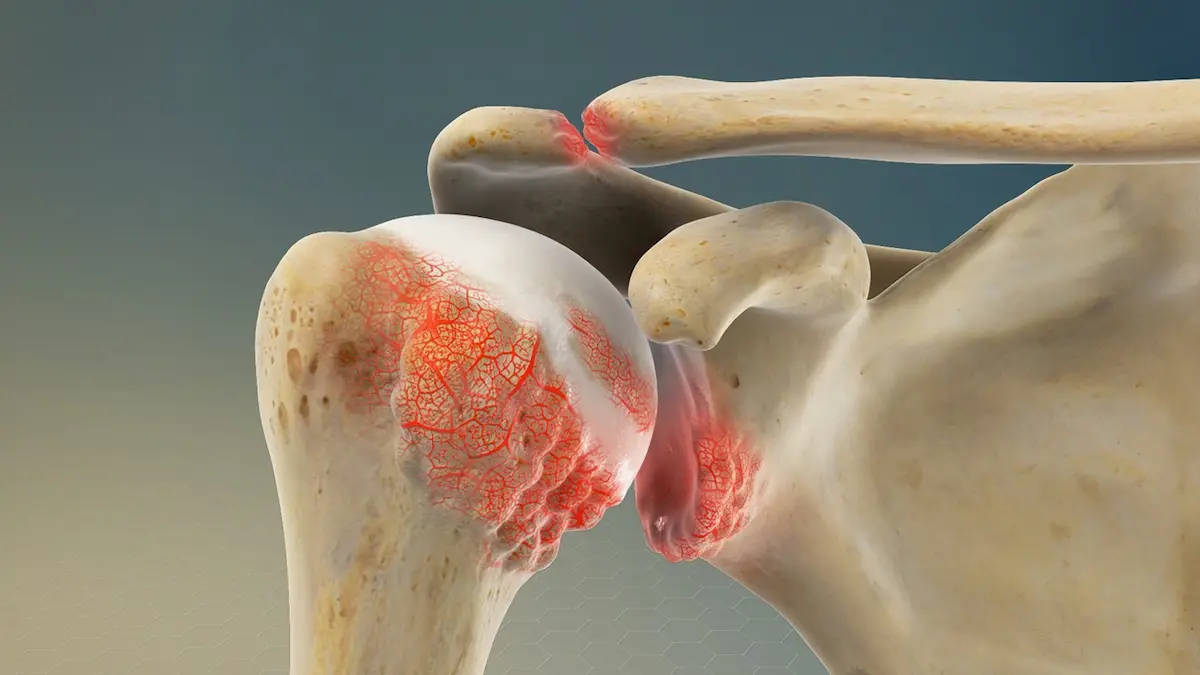 desgaste articular hombro